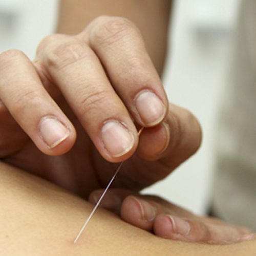 Curso acupuntura distal